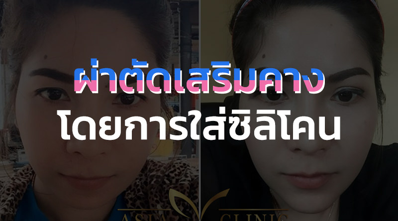 รีวิวการผ่าตัดเสริมคางโดยการใส่ซิลิโคน